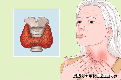 為什麼女性更容易 “中招” 甲狀腺疾病？醫生揭秘性別差異