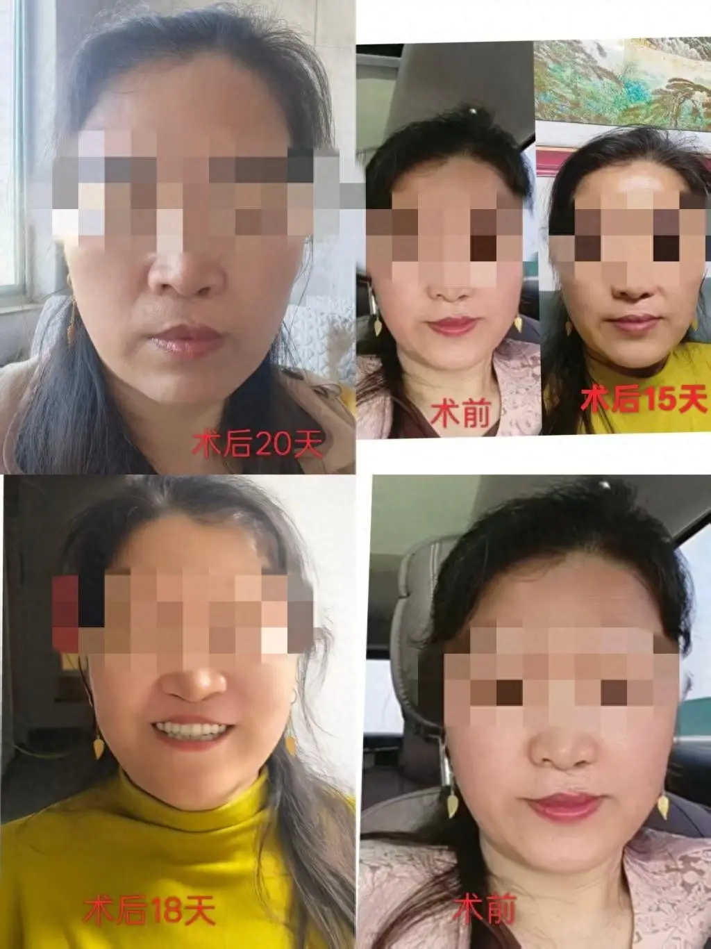 半島幫辦 | 女子花4萬多美容後變“僵硬臉”，想維權遇難題